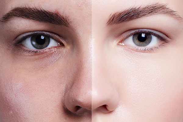 Чистка лица комбинированная: что это