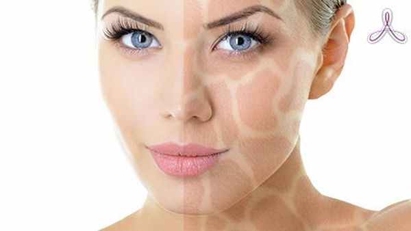 мелазма на лице