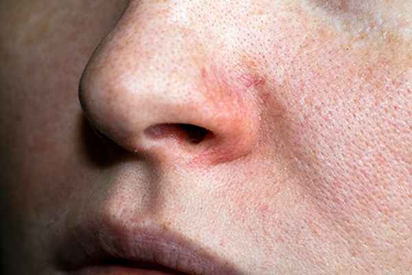 Сосуды на носу: как избавиться