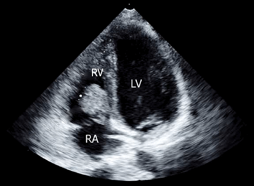 Тромбоз сердца при нефротическом синдроме