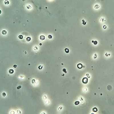 гематурия при гломерулонефрите