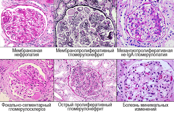гистология гломерулярных болезней