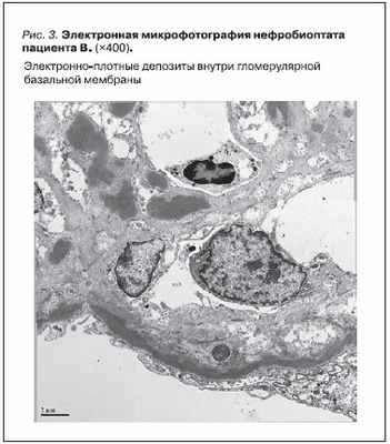Электронная микрофотография нефробиоптата пациента В.