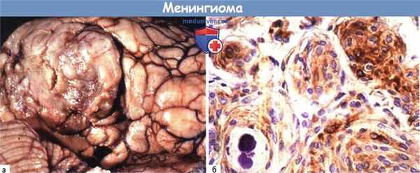 Менингиома