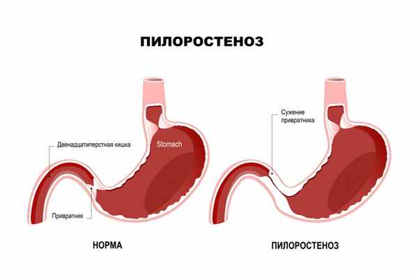 Пилоростеноз.jpg