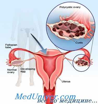 синдром поликистозных яичников (СПКЯ)