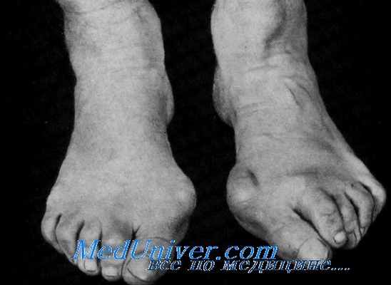 плоскостопие у танцоров