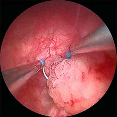 Поверхностный рак мочевого пузыря