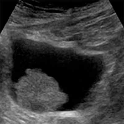 Поверхностный рак мочевого пузыря