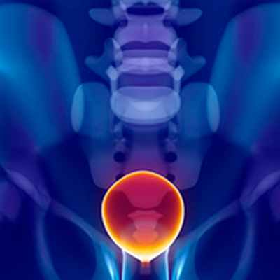 Рак мочевого пузыря