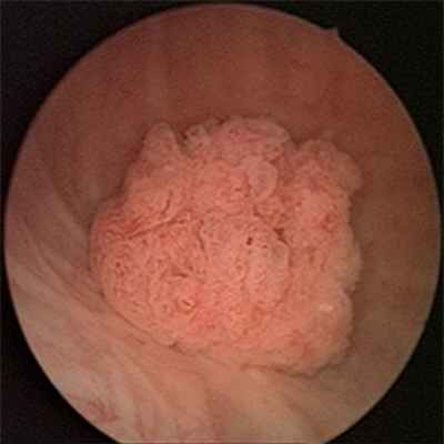 Поверхностный рак мочевого пузыря
