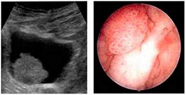 Рак мочевого пузыря диагностика