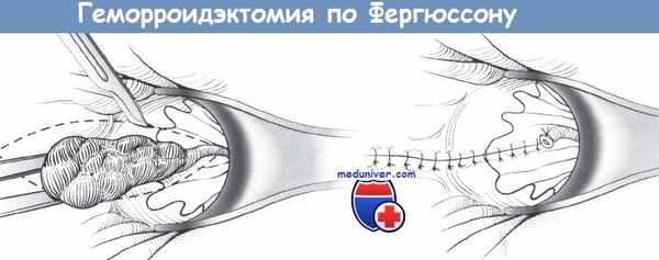 Геморроидэктомия по Фергюссону