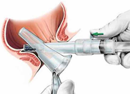 Геморроидэктомия по Миллигану-Моргану