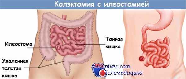 Колэктомия с илеостомией