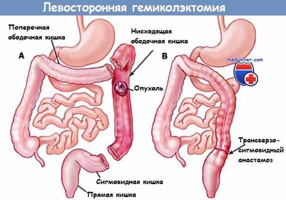 Левосторонняя гемиколэктомия