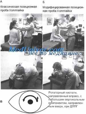 исследование позиционных проб при головокружении