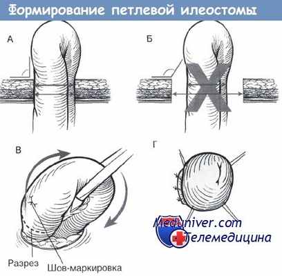 Формирование петлевой илеостомы