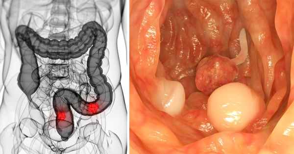 рак прямой кишки