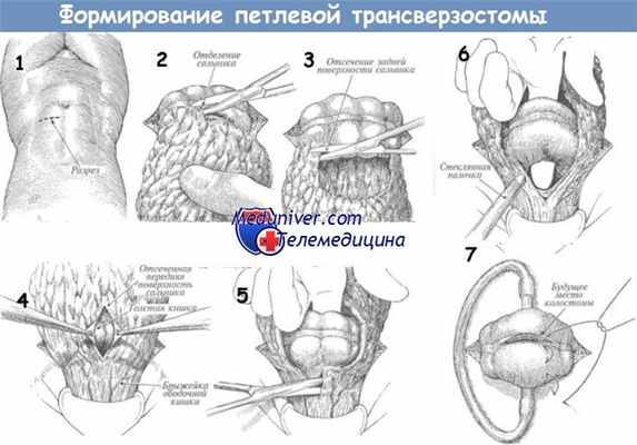 Формирование петлевой трансверзостомы