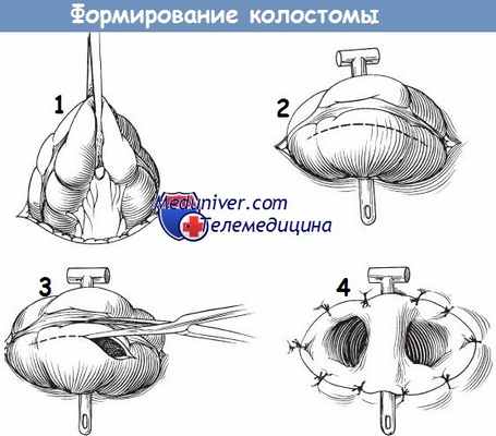 Формирование колостомы