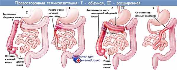 Правосторонняя гемиколэктомия