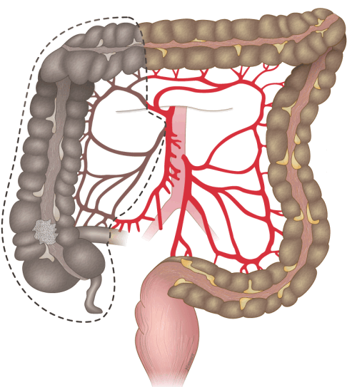 Правосторонняя гемиколэктомия