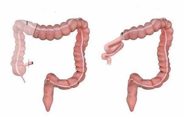 Резекция толстого кишечника