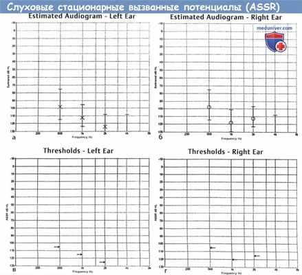Слуховые стационарные вызванные потенциалы