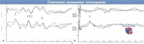 Слуховые вызванные потенциалы при опухоли VIII пары черепных нервов
