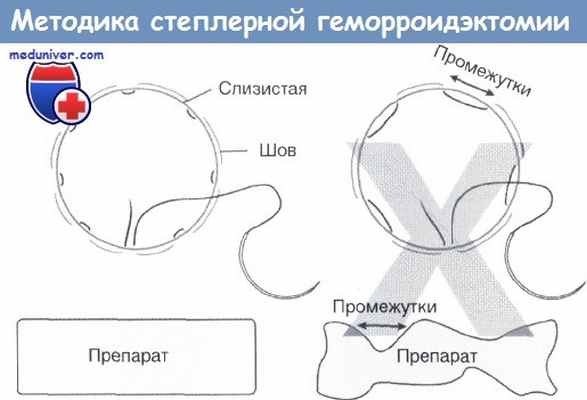 Методика степлерной геморроидэктомии