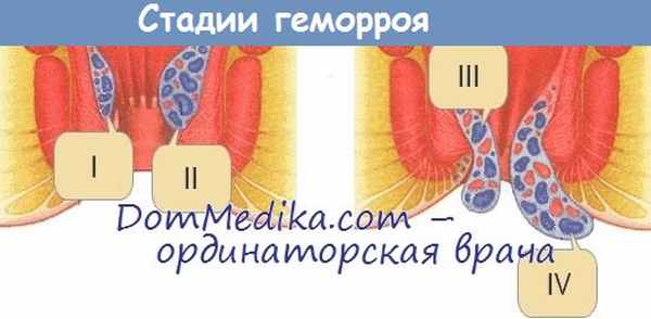 Стадии геморроя
