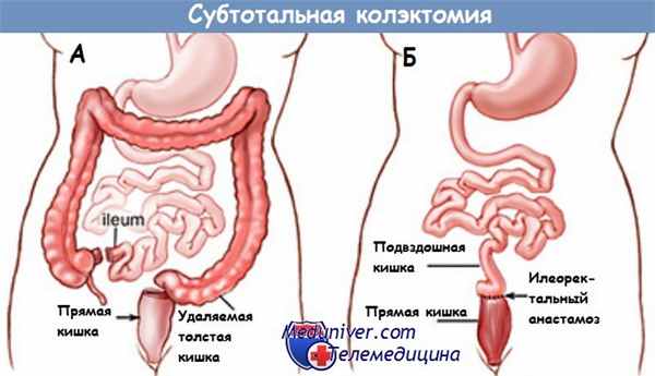 Субтотальная коэктомия