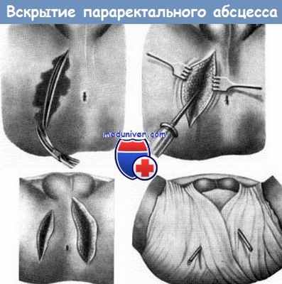 Вскрытие параректального абсцесса