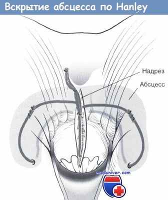 Вскрытие абсцесса по Hanley