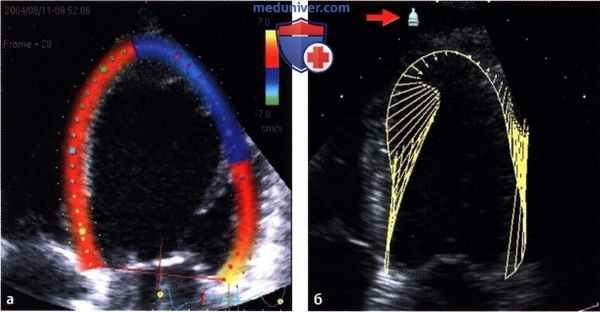 Методики распознавания паттернов допплер-эхокардиографии