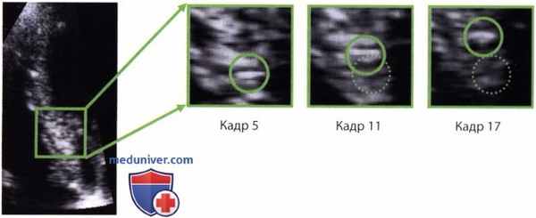 Методики распознавания паттернов допплер-эхокардиографии