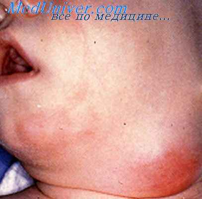 мезаденит при туберкулезе