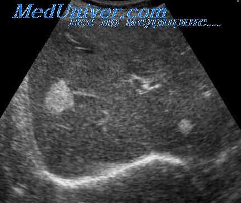 гамартома печени