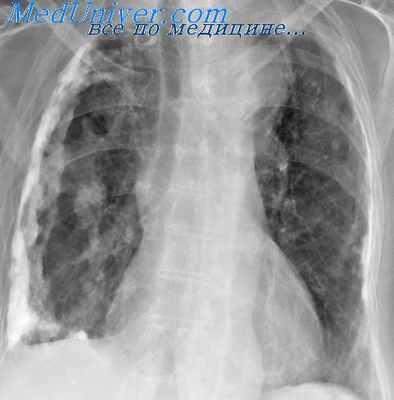 гнойный плеврит у детей