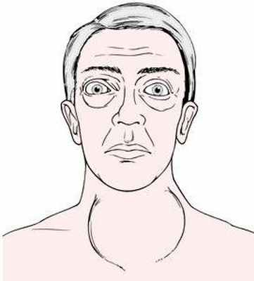 Экзофтальм - определение. Смещение глазного яблока вперед (выпученные глаза): возможные причины и терапия