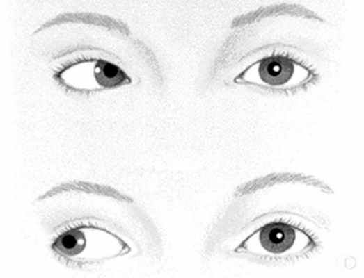 Межъядерная офтальмоплегия