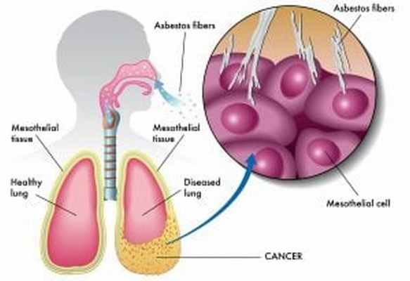 Мезотелиома плевры (эндотелиома, рак плевры): лечение, диагностика, симптомы