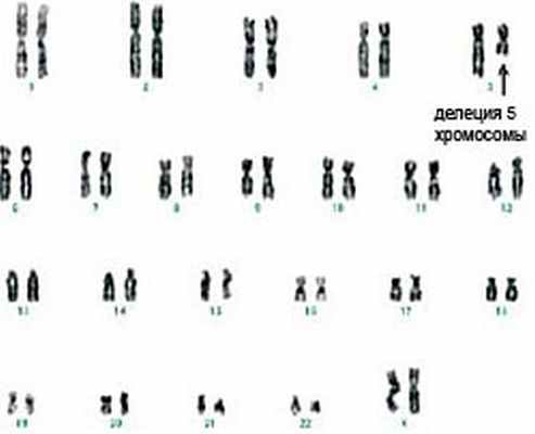 Миелодиспластические синдромы. Цитогенетический анализ
