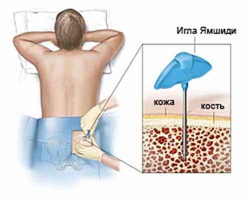 Аспирация (пункция костного мозга) и биопсия (трепанобиопсия) костного мозга
