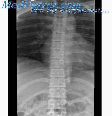 рентгенография позвоночника