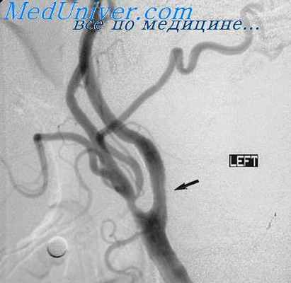 каротидная ангиография