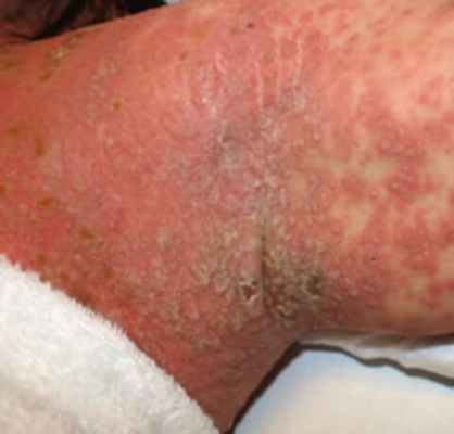 Микоплазмоз у женщин