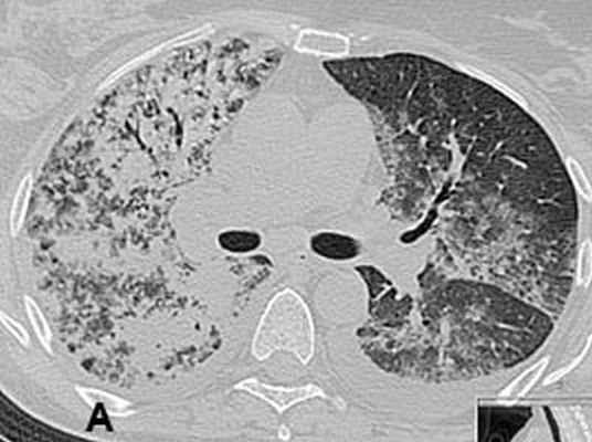 КТ органов грудной клетки
