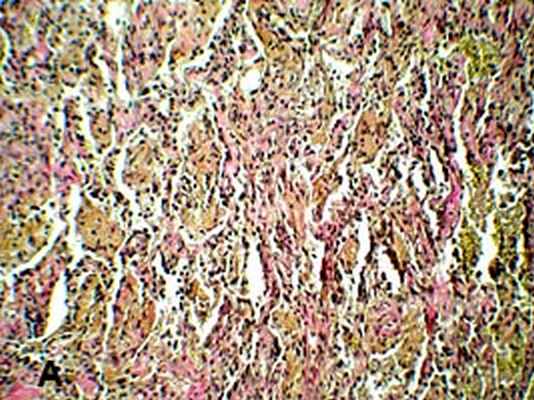 Биопсия легкого